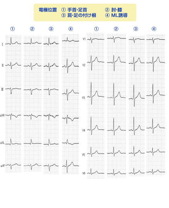 電極装着のポイント：きれいな心電図を記録するポイント ～標準12誘導心電図編～｜正しくお使いいただくために｜医療関係の皆様へ｜日本光電
