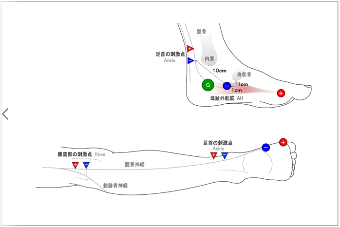 誘発反応測定装置 MEB-2300/9600 の糖尿病性神経障害レポート