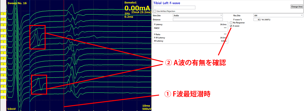 誘発反応測定装置 MEB-2300/9600 の糖尿病性神経障害レポート